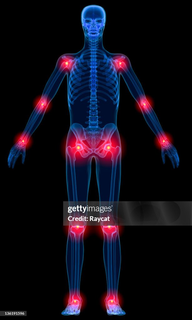 Inflammation of joints