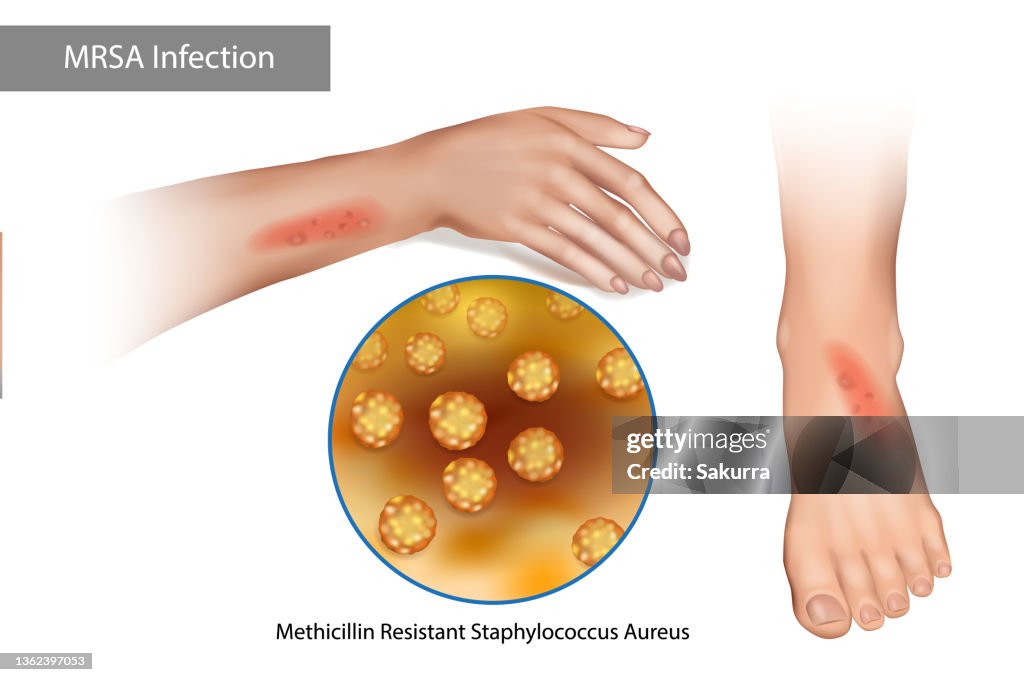 Mrsa Superbug Infection Methicillin Resistant Staphylococcus Aureus ...