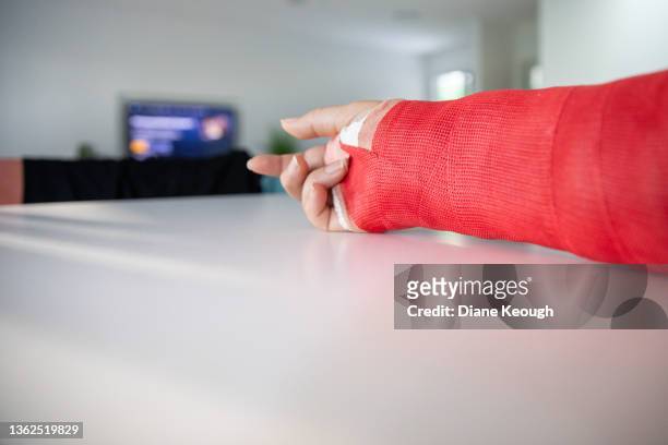 Hand in Cast on White Background Stock Image - Image of fiberglass