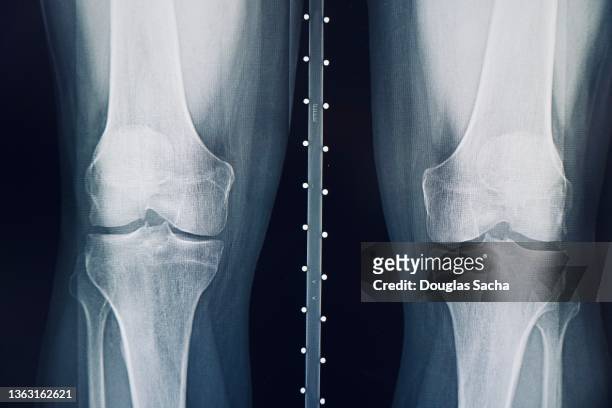x-ray image of the human knees - tibia stock pictures, royalty-free photos & images