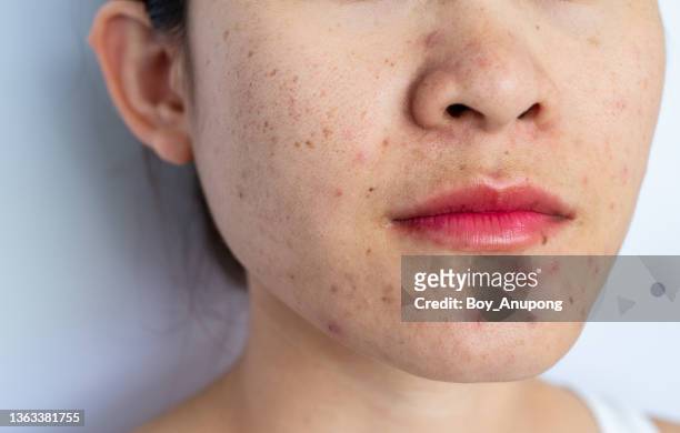 close up of asian woman having acne inflammation on her face. - narbe hautmerkmal stock-fotos und bilder
