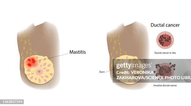 Mastitis Example Mastitis Photos and Premium High Res Pictures - Getty Images