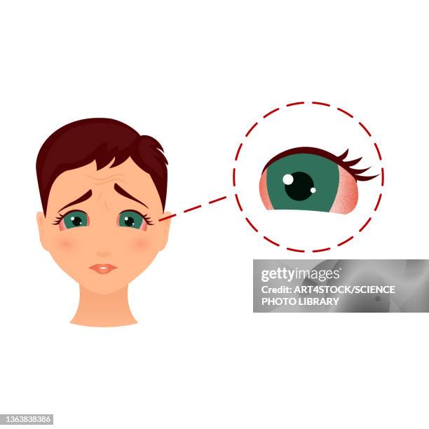 51 Ilustraciones de Conjuntivitis - Getty Images 51 Ilustraciones de Conjuntivitis - Getty Images