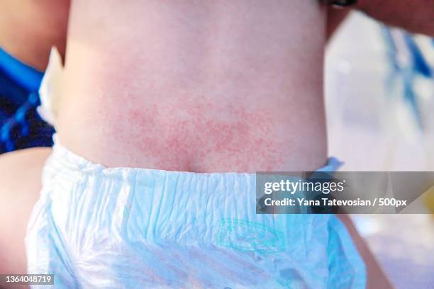 babys back rash is allergic selective focus - diaper rash stock-fotos und bilder