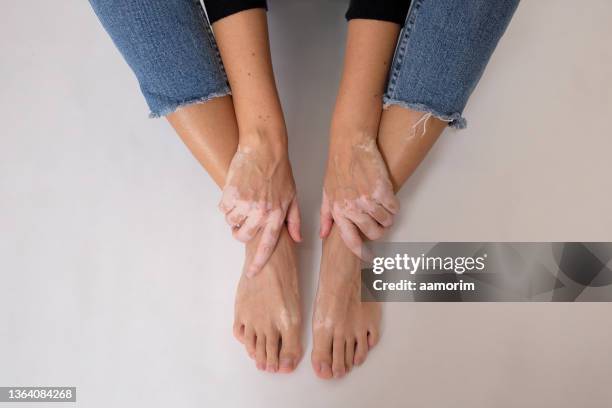 hände und füße mit vitiligo - vitiligo stock-fotos und bilder