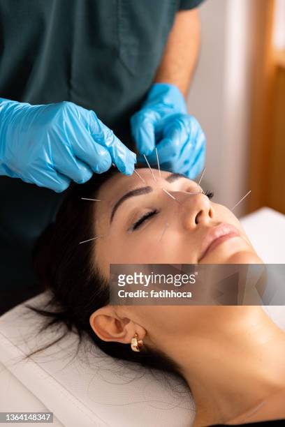 a doctor practices acupuncture therapy. - acupuncture stock pictures, royalty-free photos & images