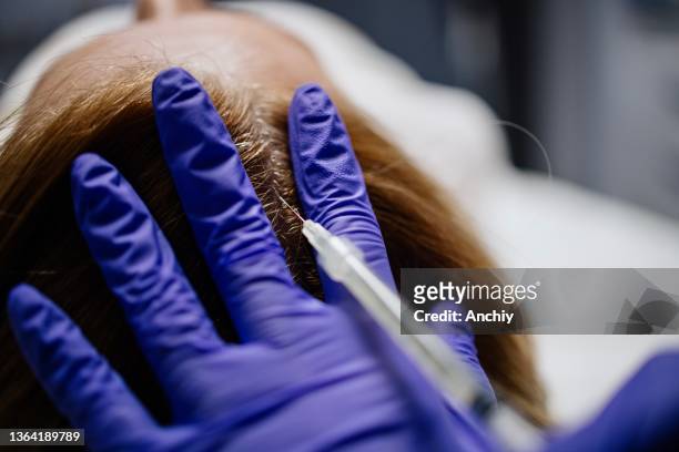 processus de thérapie prp pour la perte de cheveux - cheveux secs photos et images de collection