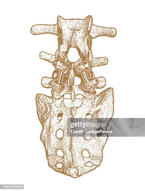 lendenwirbelsäulen-fusionschirurgie - neuropathy stock-grafiken, -clipart, -cartoons und -symbole