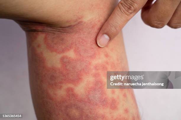 acute atopic dermatitis on the legs, a red, inflamed, scaly rash on the legs of a teenager with severe eczema. - leg wound fotografías e imágenes de stock