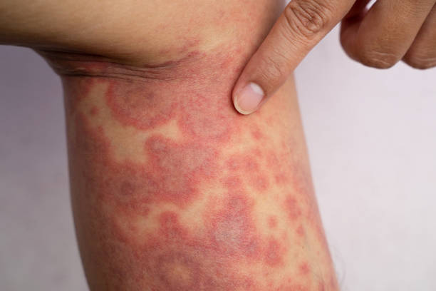 Chronic Lp Rash 152 Chronic Wound Stock Photos, High-Res Pictures, and Images - Getty ...