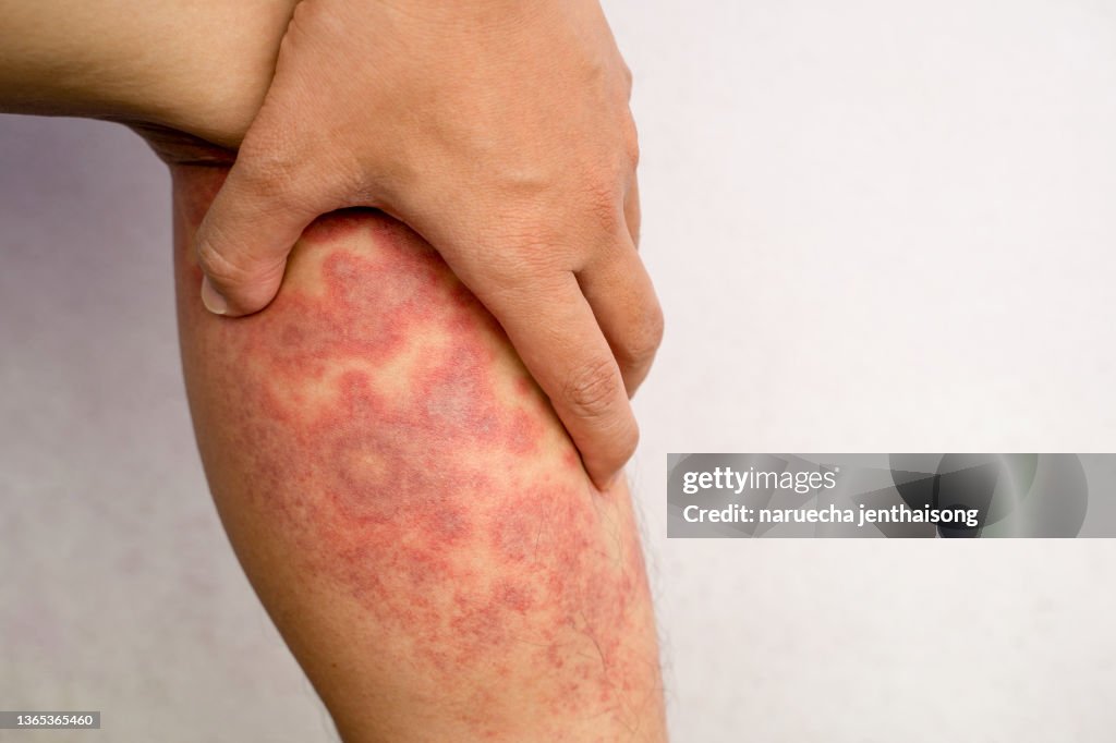 Random Rash On Leg Acute Atopic Dermatitis On The Legs A Red Inflamed Scaly Rash On The ...