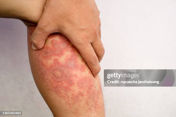 acute atopic dermatitis on the legs, a red, inflamed, scaly rash on the legs of a teenager with severe eczema. - chronic wound stock pictures, royalty-free photos & images