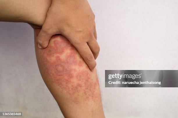Microembolic Rash Legs 35 Eczema Legs Stock Photos, High-Res Pictures, and Images - Getty Images