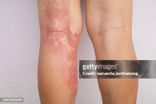 Woman with vitiligo holding pillow between legs on bed in front of