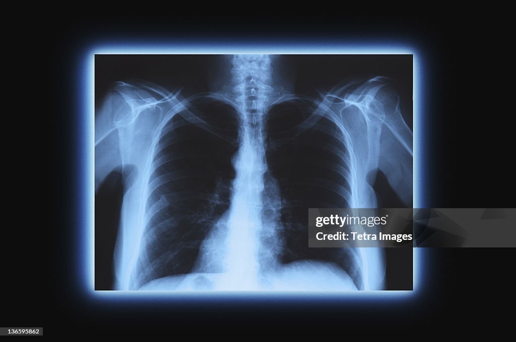 Studio shot of chest x-ray