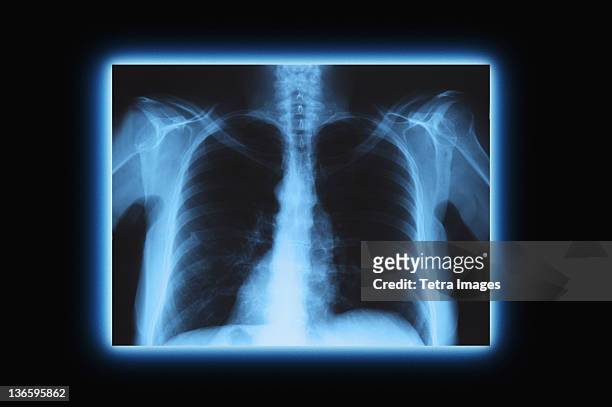 studio shot of chest x-ray - xray photography stock pictures, royalty-free photos & images