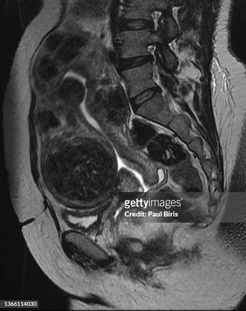 magnetic resonance images of woman with uterine fibroids , sagital t2 image - fibroids 個照片及圖片檔
