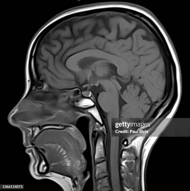 sagital view mri scan of the brain t1 - mri ストックフォトと画像
