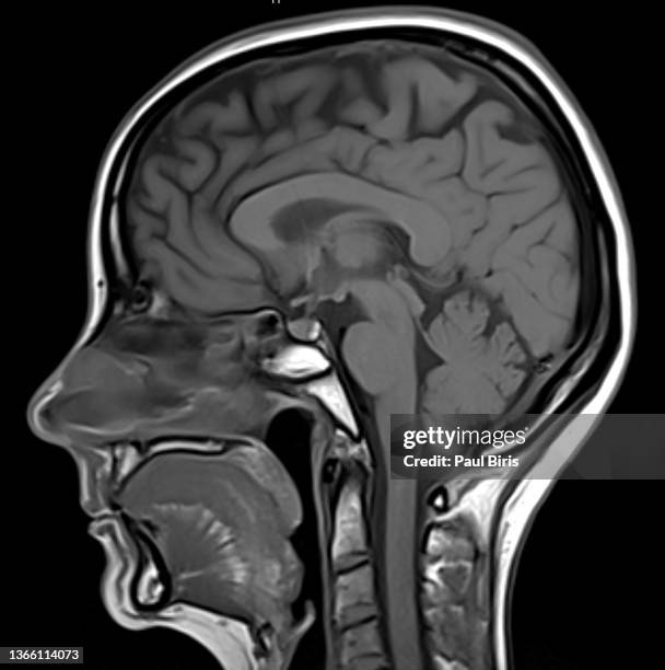 sagital view mri scan of the brain t1 - brain stroke stock pictures, royalty-free photos & images