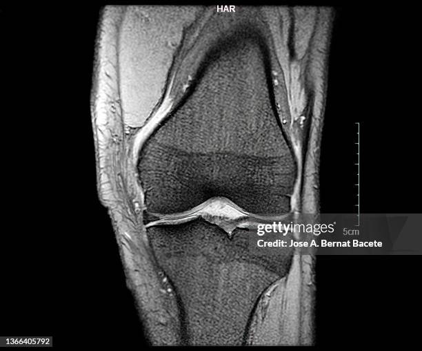 magnetic resonance imaging mri knee. - rip science stock pictures, royalty-free photos & images