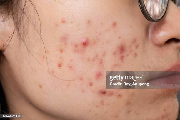 cropped shot of woman having problems of acne inflamed on her face. - oily skin stock pictures, royalty-free photos & images