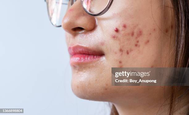 cropped shot of woman having problems of acne inflamed on her cheek. - acnes stock pictures, royalty-free photos & images