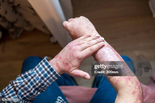 problema de la piel del adulto - psoriasis fotografías e imágenes de stock