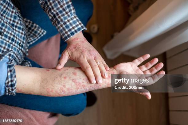 adult skin problem - hand eczema stock pictures, royalty-free photos & images