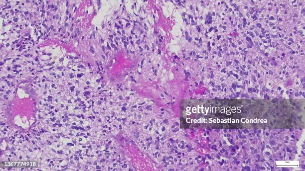 microscope of adenoid cystic carcinoma, rare type of cancer exist in many different body sites. this tumor occurs in the salivary glands, - chercher sous photos et images de collection
