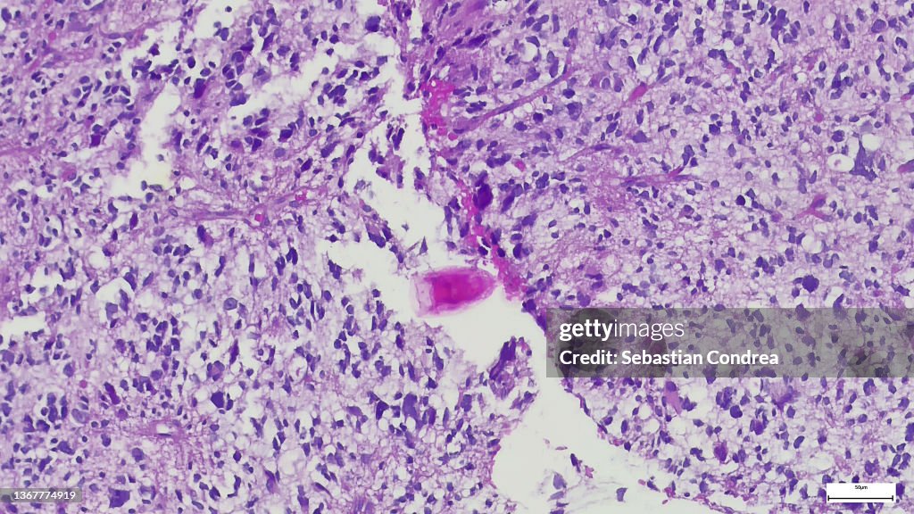 Serous cells (dark, granular cells) and a duct. The serous cells show secretion granules which are a source of enzymes (salivary amylase). Human