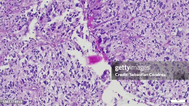 serous cells (dark, granular cells) and a duct. the serous cells show secretion granules which are a source of enzymes (salivary amylase). human - cancer center bildbanksfoton och bilder