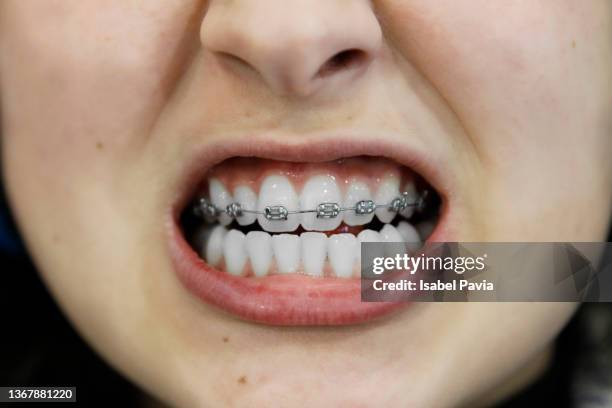 young woman with braces on her teeth, close-up of mouth - teeth braces stock pictures, royalty-free photos & images