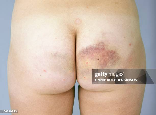 bruised buttock - bruise stock pictures, royalty-free photos & images