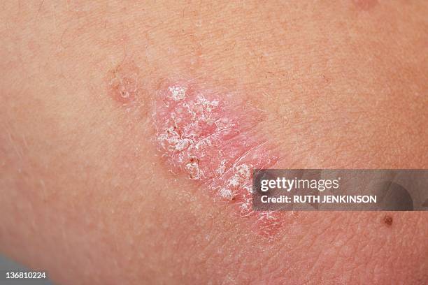 psoriasis - one teenage girl only stock pictures, royalty-free photos & images