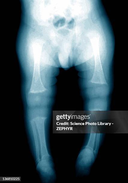 rickets, x-ray - rickets disease photos et images de collection
