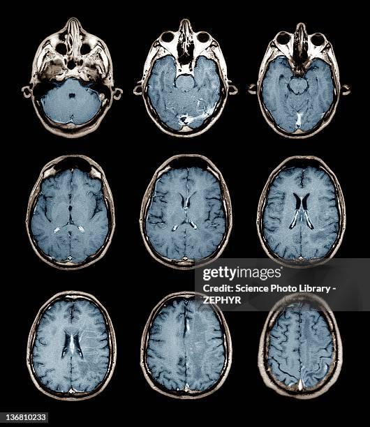 normal brain, mri scans - brain scan stock-fotos und bilder