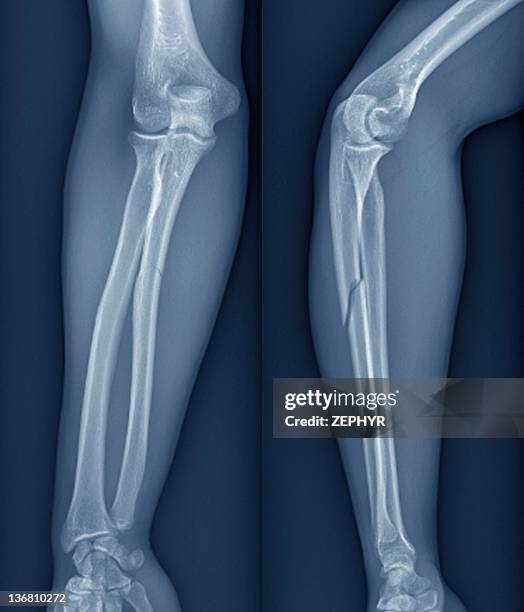 broken arm, x-ray - armknochen stock-fotos und bilder