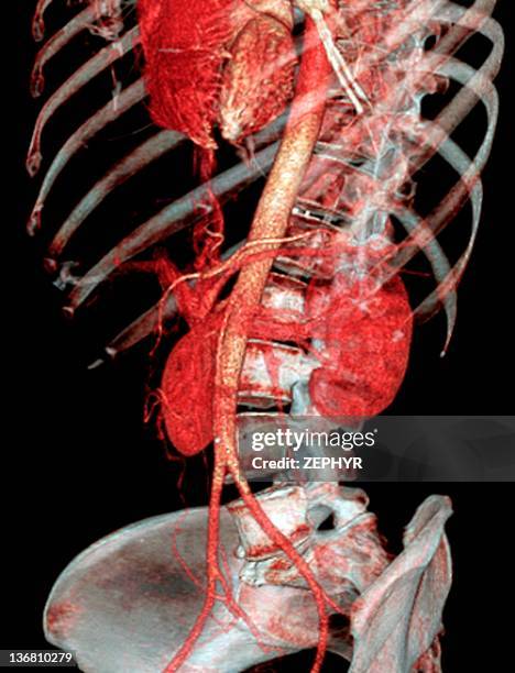 normal abdomen, 3d ct scan - bekkenslagader stockfoto's en -beelden