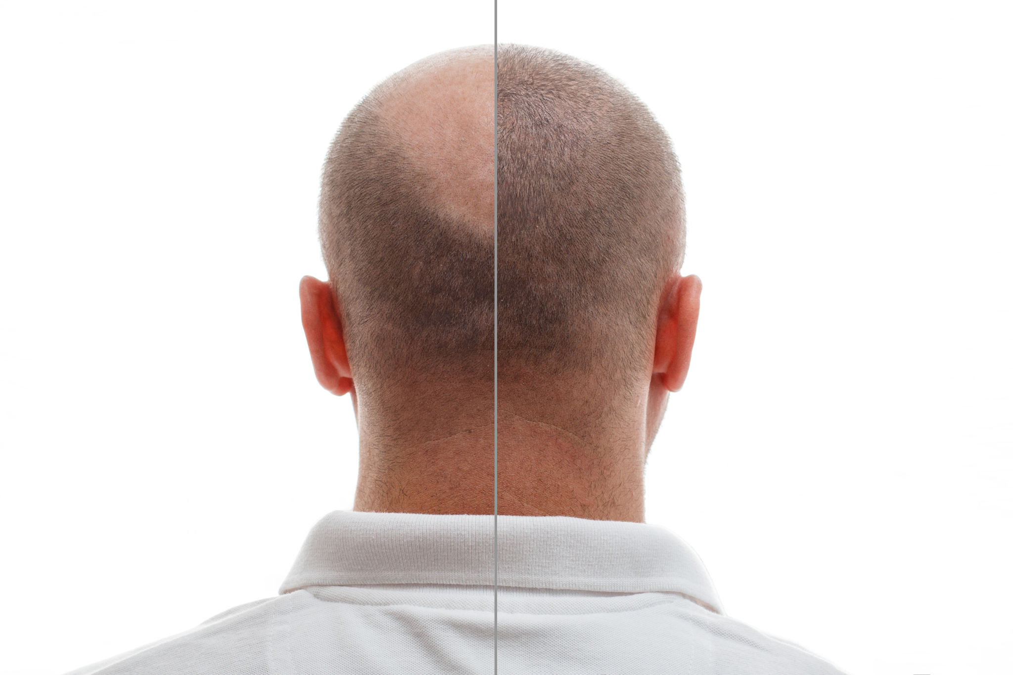 post care hair transplant