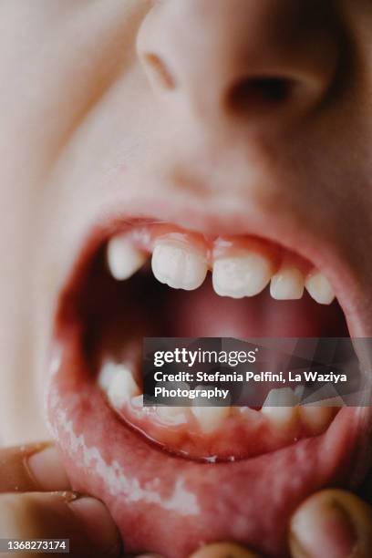 extreme close up on a child's mouth open with gaps among the teeth. - herpes labial - fotografias e filmes do acervo