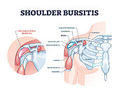 Shoulder bursitis as medical painful bursa inflammation outline diagram