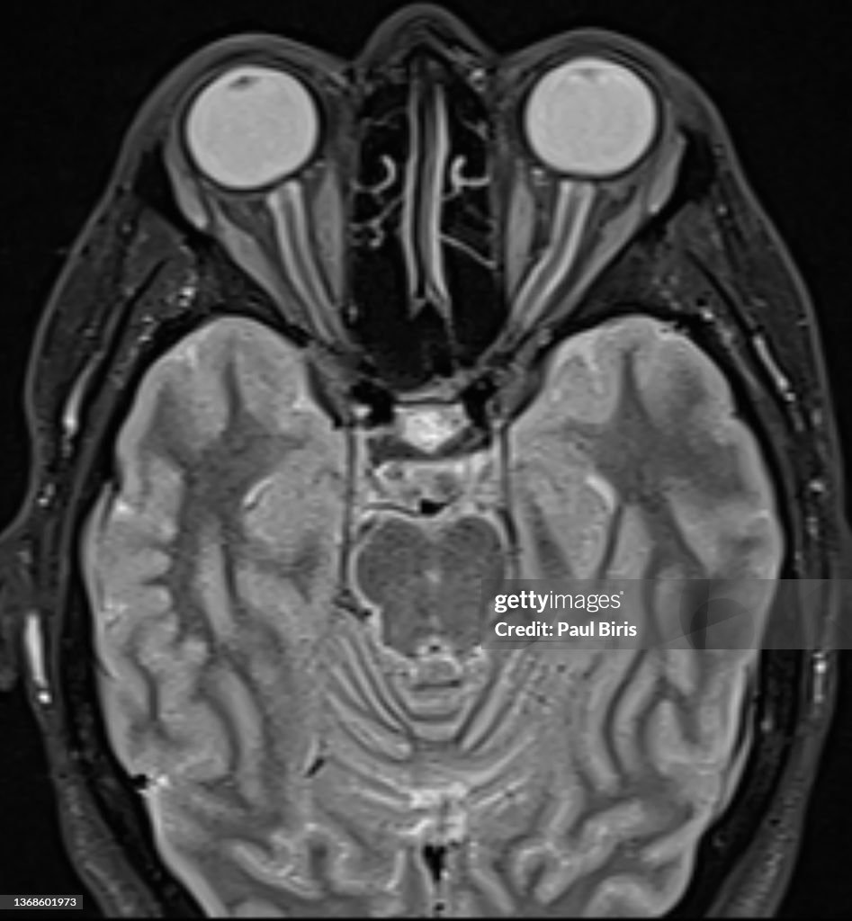 Magnetic resonance imaging of normal optic nerves seen on axial STIR image