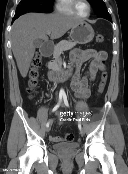 ct scan of abdomen showing liver, bowels, pancreas and aorta in coronal view - pancreatic cancer stockfoto's en -beelden