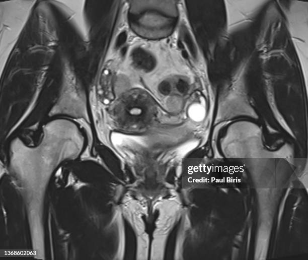 magnetic resonance imaging of the female hip - hip bone stock pictures, royalty-free photos & images