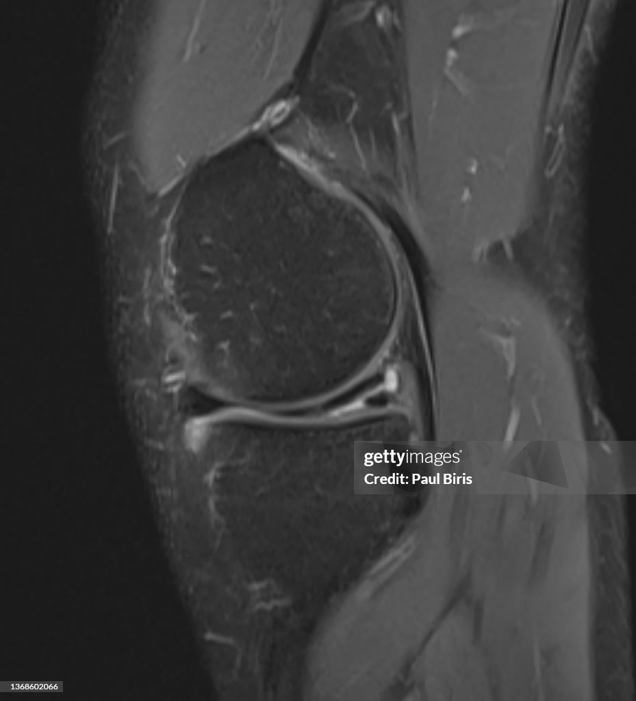 Magnetic resonance imaging MRI knee posterior horn medial meniscus tear