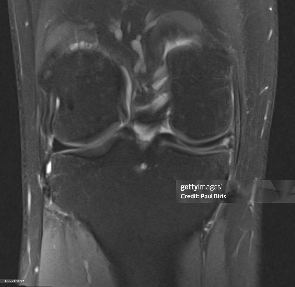 Magnetic resonance imaging MRI knee posterior horn medial meniscus tear