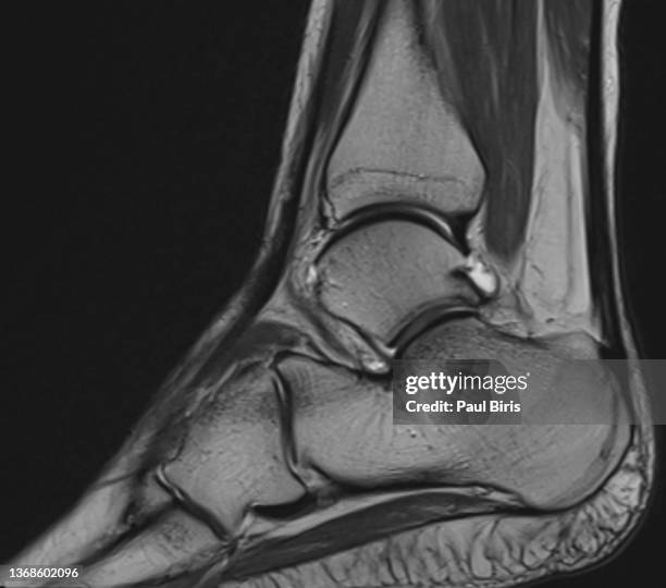 mri magnetic resonance imaging of the foot and ankle - tendon stock pictures, royalty-free photos & images