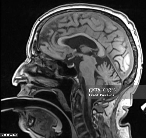 brain mri scan of healthy male ( magnetic resonance imaging) - intubation fotografías e imágenes de stock