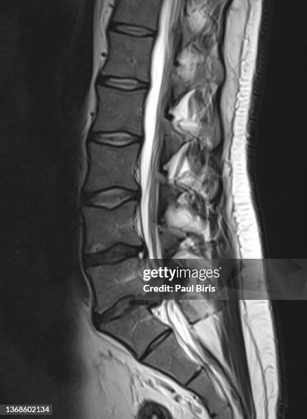 lumbar disk herniation l5-s1, mri sagittal view t2 image - brain and spinal cord mri stock pictures, royalty-free photos & images