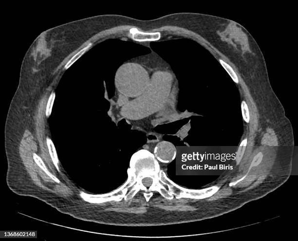 bilateral  gynecomastia seen on ct scan of the torax on the middle age adult - ct scanner stockfoto's en -beelden